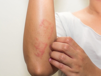 Dermatitis Atópica: Todo lo que necesitas saber