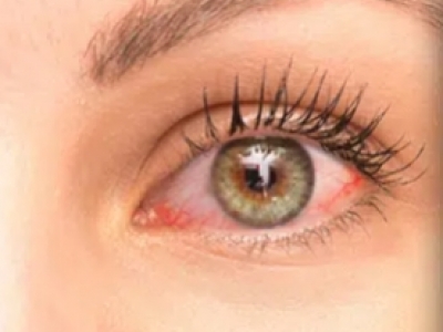 ¿Sufro de ojo seco?